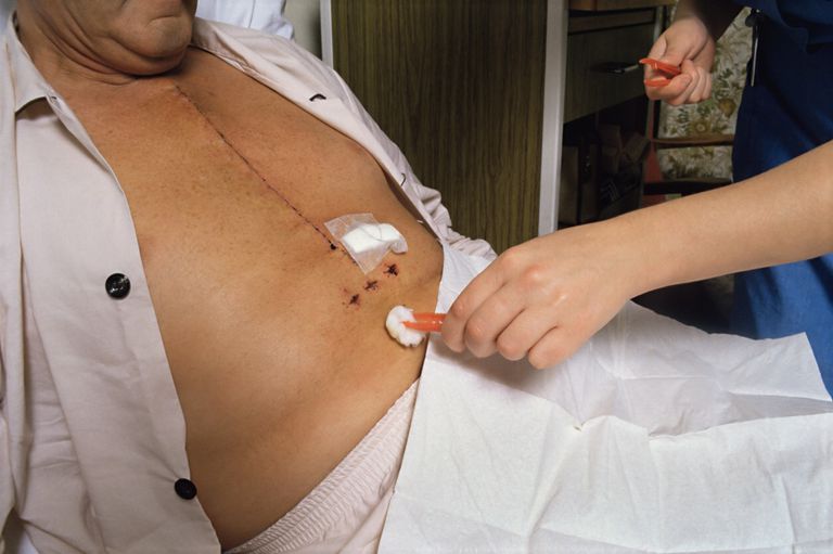 Precauciones para el esternón después de una cirugía a corazón abierto