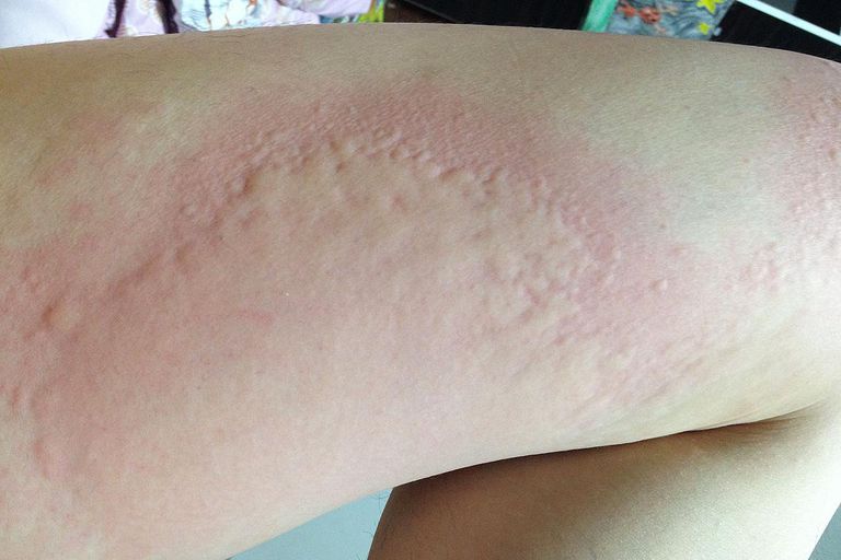 Síntomas y riesgos de la alergia a las sulfas