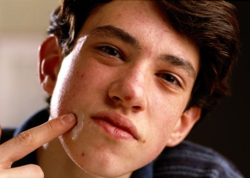 Tratamientos y prescripciones para el acné en adolescentes