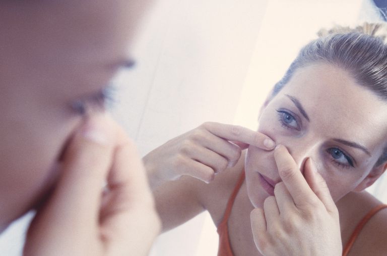 Principales mitos sobre el acné sobre las causas del acné