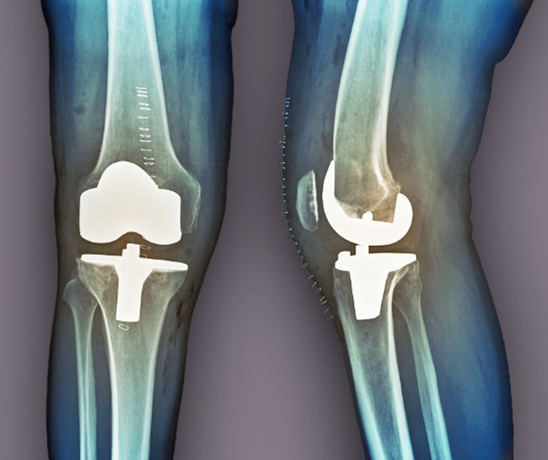 Reemplazo de rodilla total versus parcial