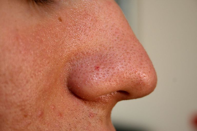 Tipos de manchas de acné no inflamadas o comedones