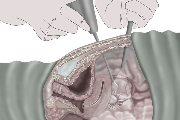 Comprender la ligadura de trompas laparoscópica