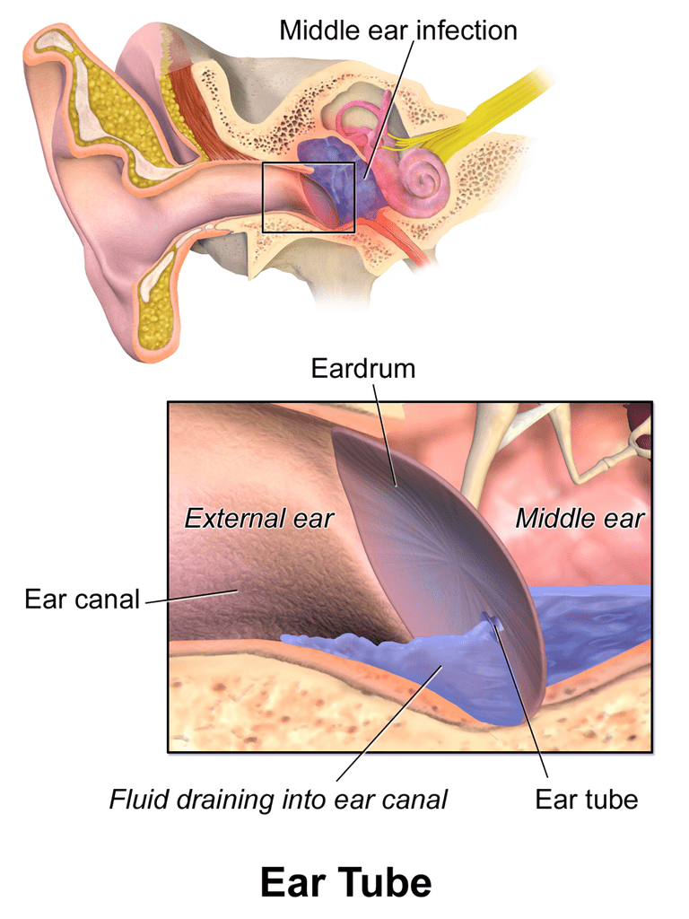 Tubos de ventilación para las orejas