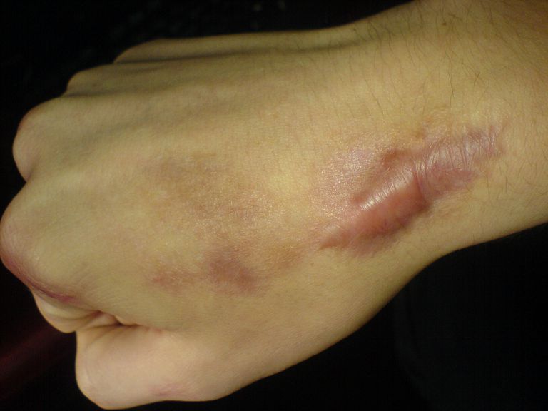¿Cuáles son las causas de las cicatrices queloides?
