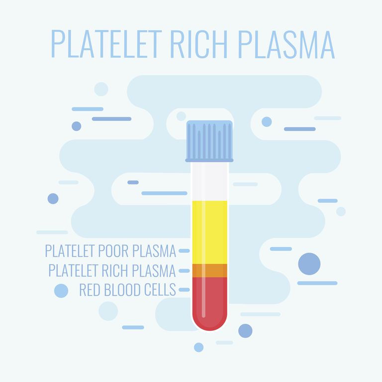 ¿Qué son las inyecciones de plasma rico en plaquetas (PRP)?
