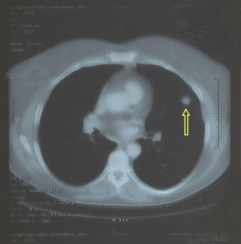 ¿Qué son los nódulos pulmonares solitarios?