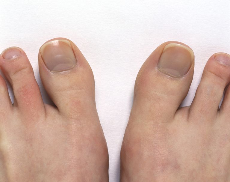 ¿Cuáles son los síntomas de la artritis del dedo gordo del pie (Hallux Rigidus)?