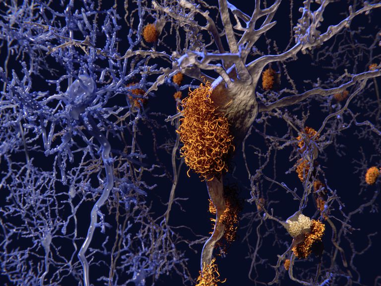 ¿Qué causa la enfermedad de Alzheimer?