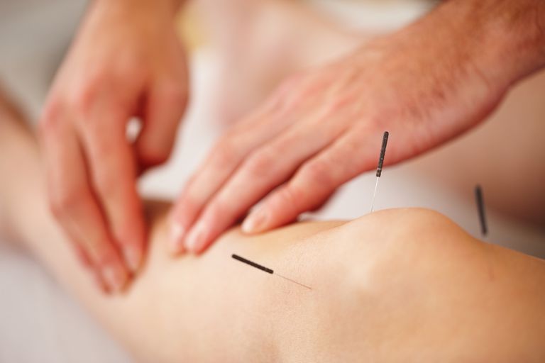 ¿Qué es la acupuntura? ¿Cuales son los beneficios?