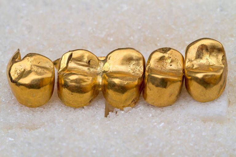 ¿Qué es una corona dental de oro?