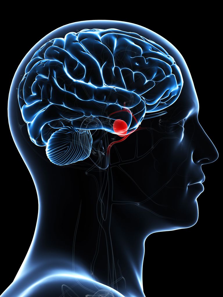 ¿Cuál es el pronóstico de los aneurismas cerebrales?