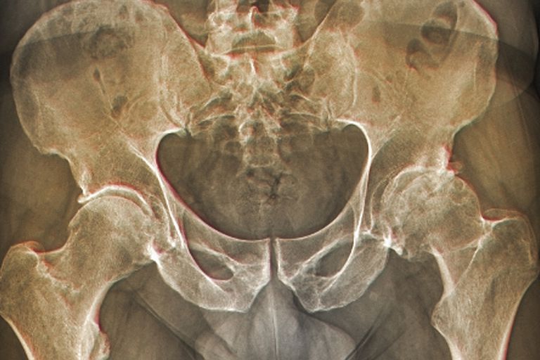 Lo que necesita saber sobre la osteoartritis de la cadera