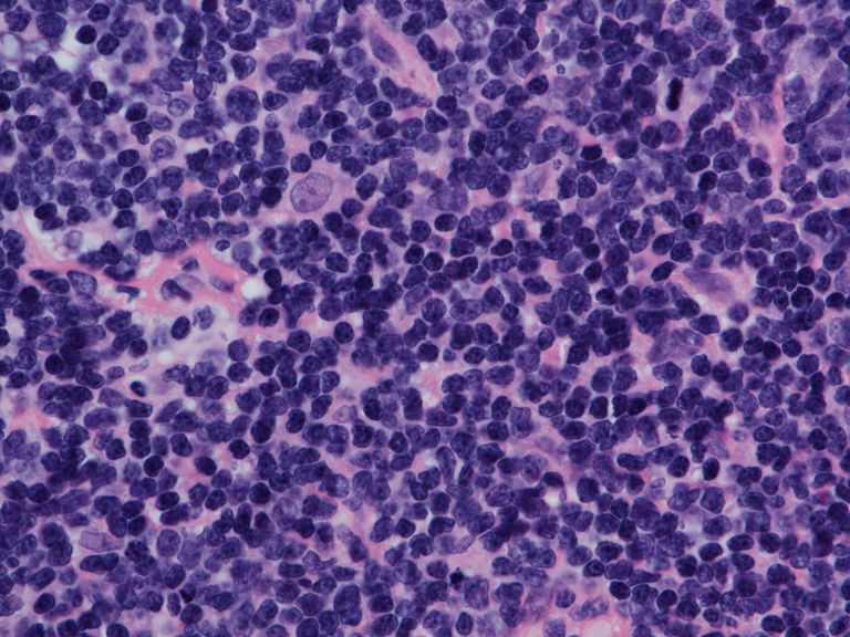 Lo que debe saber sobre el linfoma de células del manto