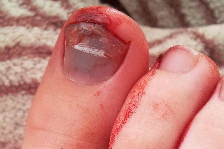 Cuándo buscar tratamiento para el trauma de las uñas de los pies