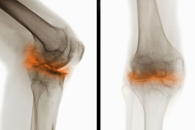 Evidencia de rayos X de la osteoartritis
