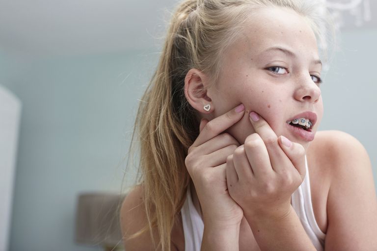10 Cosas que las adolescentes deben saber sobre el acné