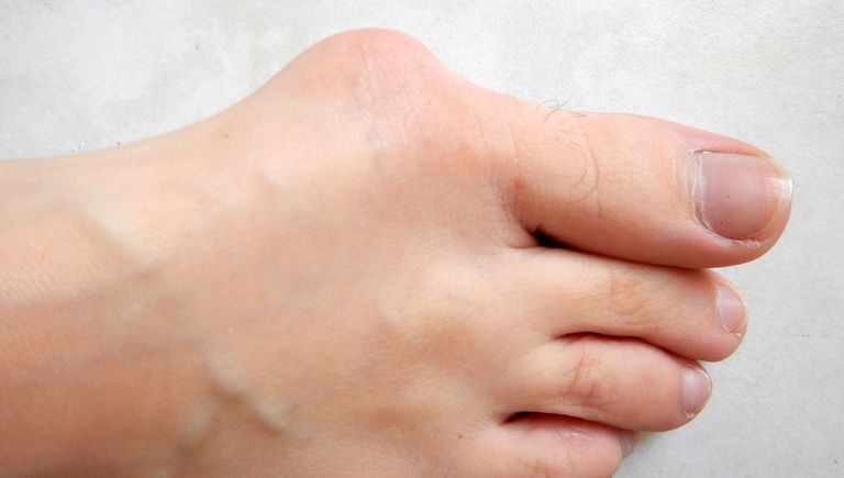 4 Condiciones comunes que afectan los dedos de sus pies