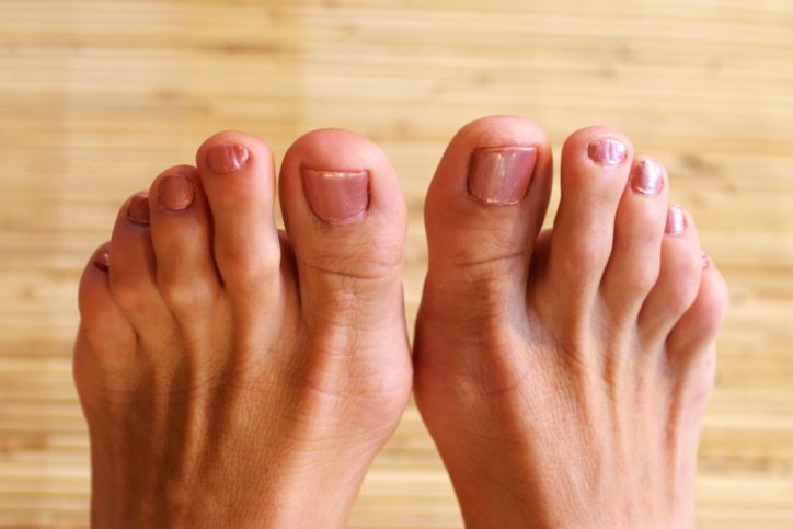 4 Condiciones comunes que afectan los dedos de sus pies