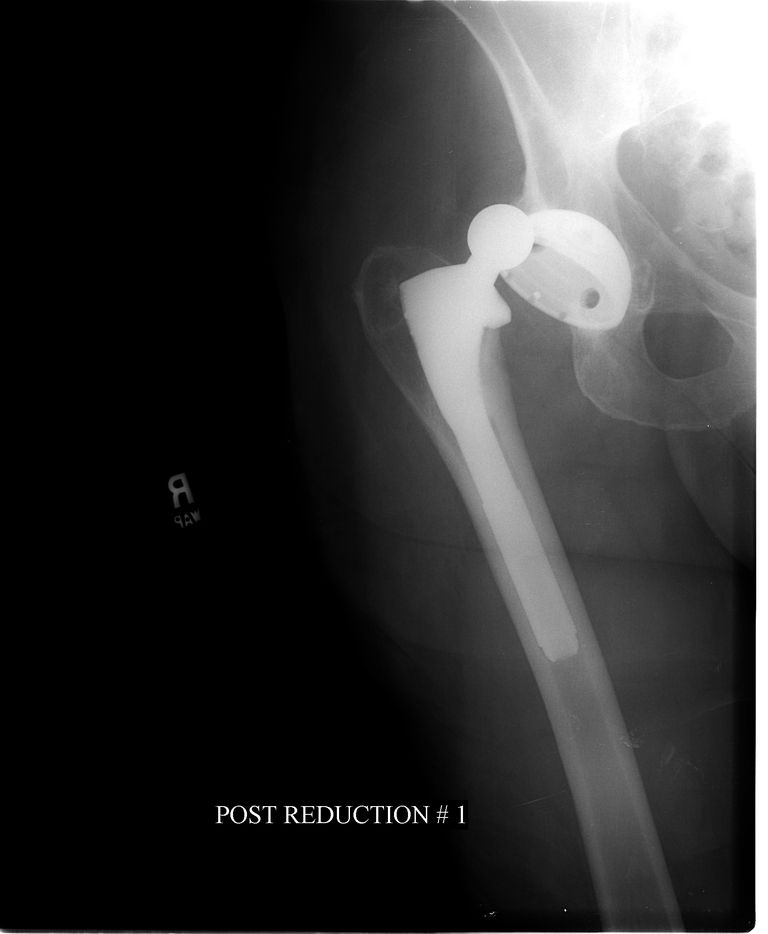 4 Complicaciones de la cirugía de reemplazo de cadera