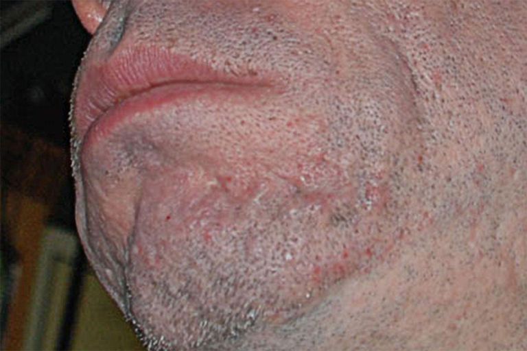 4 Tipos de cicatrices del acné y sus tratamientos