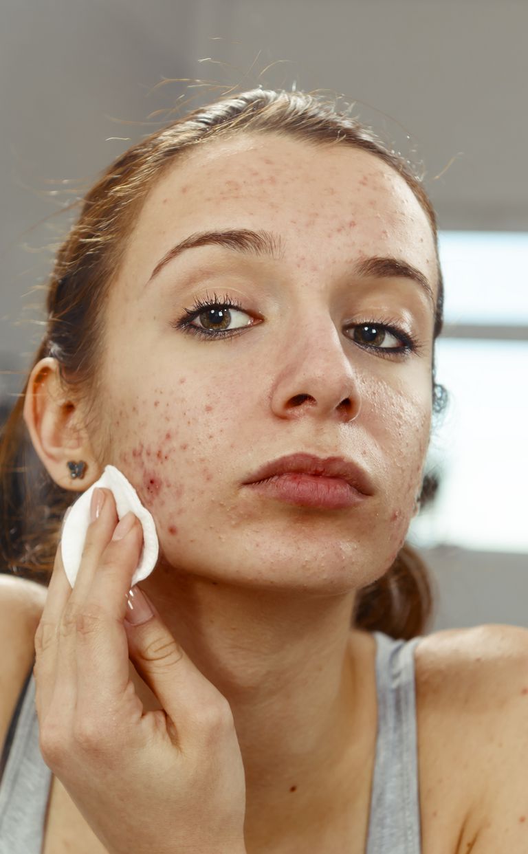 5 Mitos sobre el tratamiento del acné