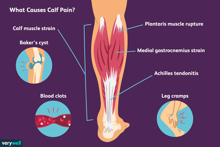 7 Causas comunes del dolor en la pantorrilla y cómo tratarlas