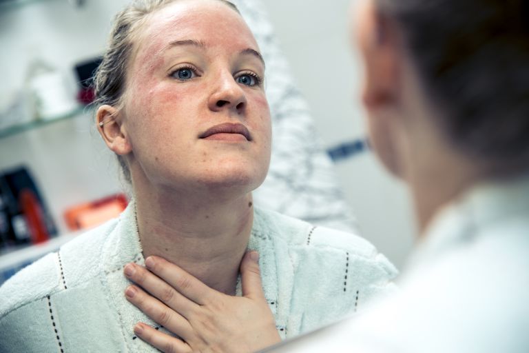 7 Formas de sobrellevar el eczema en la cara