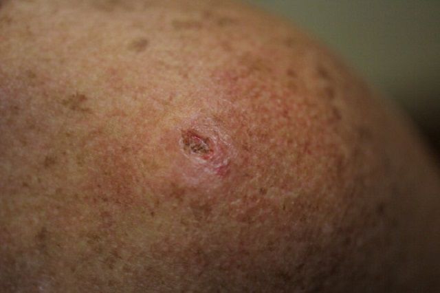 8 Hechos poco conocidos sobre el cáncer de piel