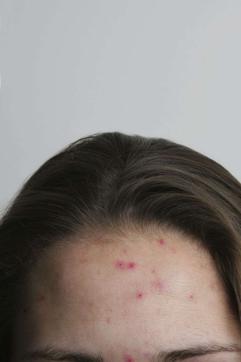 Acanya Gel para el tratamiento del acné