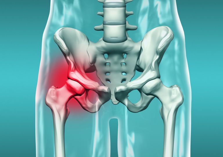 Fractura acetabular es un zócalo de cadera roto