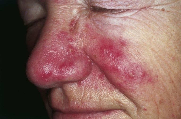 Acne Look-Alikes: Otras afecciones de la piel que causan espinillas
