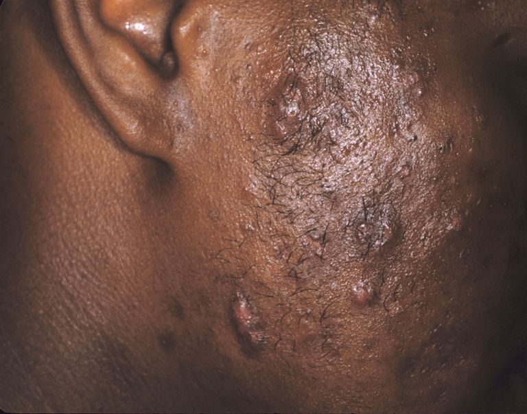 Acne Look-Alikes: Otras afecciones de la piel que causan espinillas