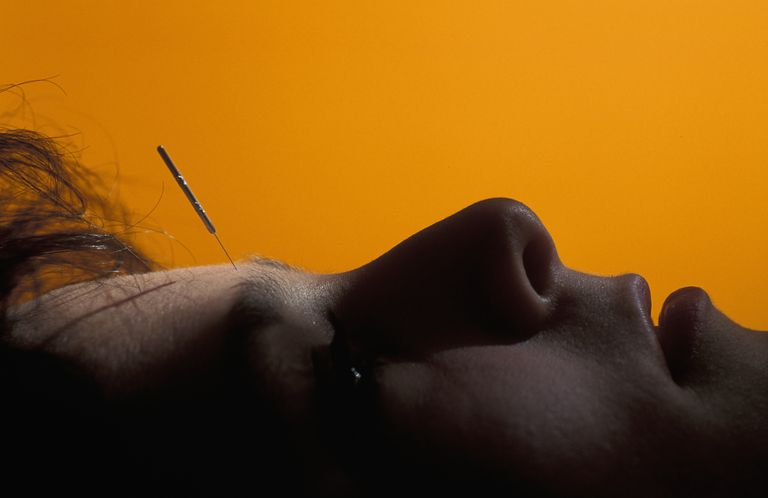 El enfoque de un acupuntor para las migrañas
