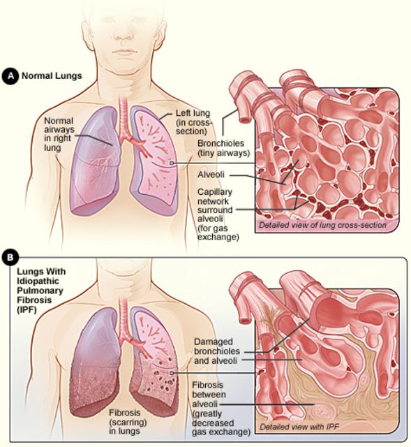 Una visión general de la fibrosis pulmonar idiopática