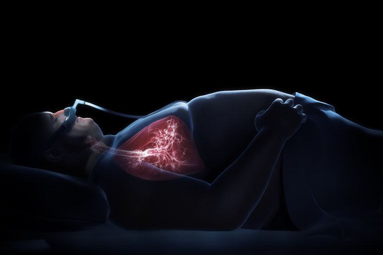 ÍNdice de apnea-hipopnea (IAH) en la prueba de apnea del sueño