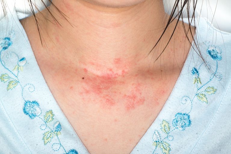 ¿Las alergias son la causa de la erupción de la piel que pica?