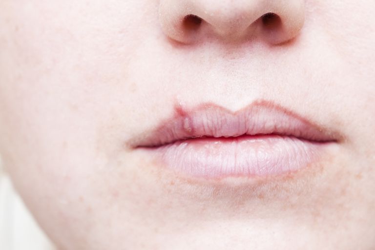 ¿Los herpes labiales y las ampollas de fiebre son causados ​​por resfriados?