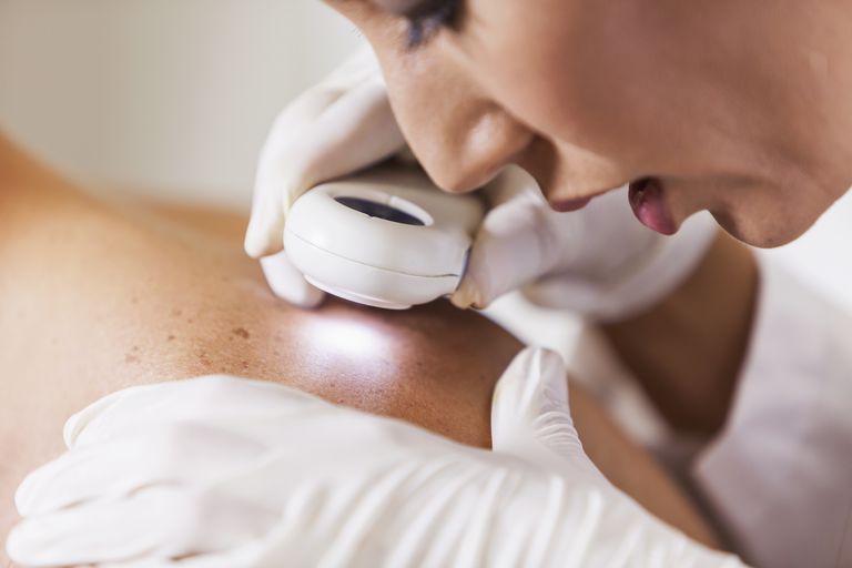 ¿Las personas con EII están en riesgo de desarrollar cáncer de piel?
