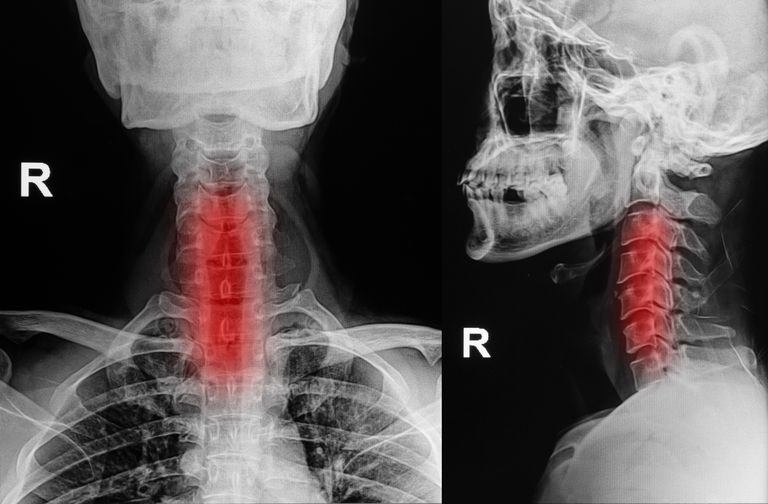 Artritis en el cuello - Espondilosis cervical