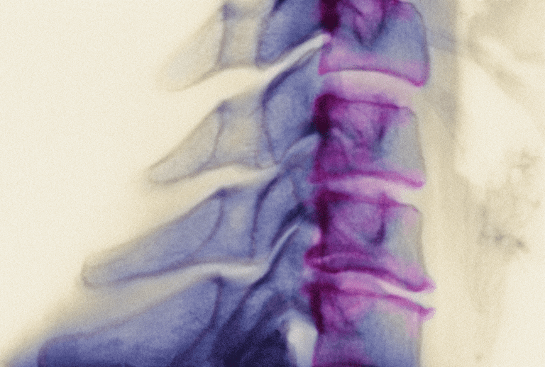 Artritis en el cuello - Espondilosis cervical