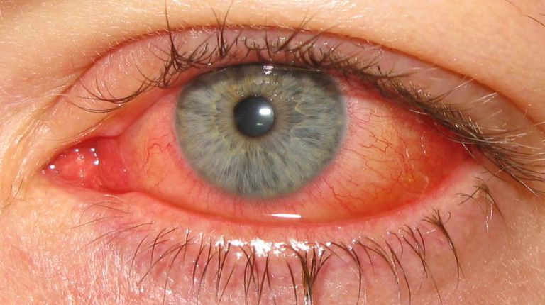 Alergias ke La queratoconjuntivitis atópica (AKC) es una forma grave de alergia ocular que puede afectar la córnea del ojo y el revestimiento interno de los párpados inferiores. AKC por lo general afecta a adultos jóvenes, que comienza a finales de la adolescencia hasta principios de los años veinte y puede persistir durante décadas. La mayoría de las personas con AKC también tienen dermatitis atópica, rinitis alérgica y / o asma.