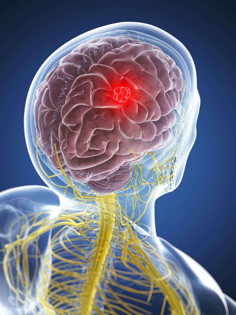 Datos básicos sobre los tumores cerebrales