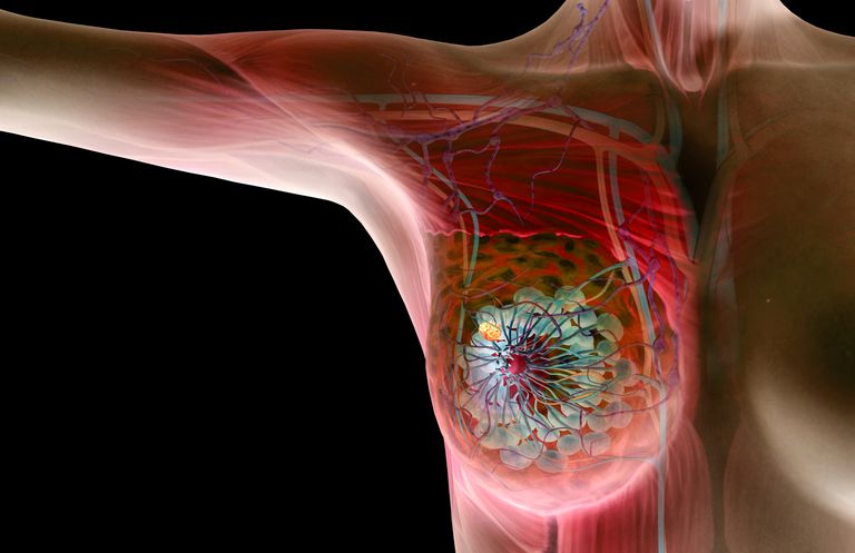 Conceptos básicos sobre bultos de seno benignos y cancerosos