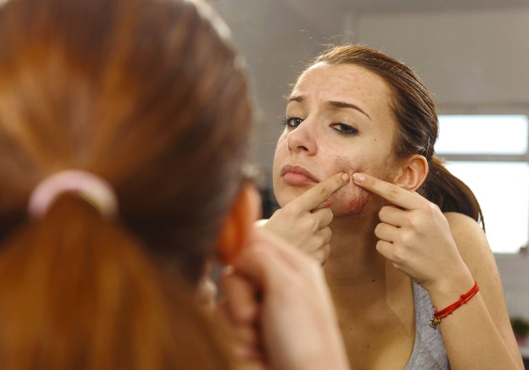 Beneficios y riesgos de Accutane para el acné