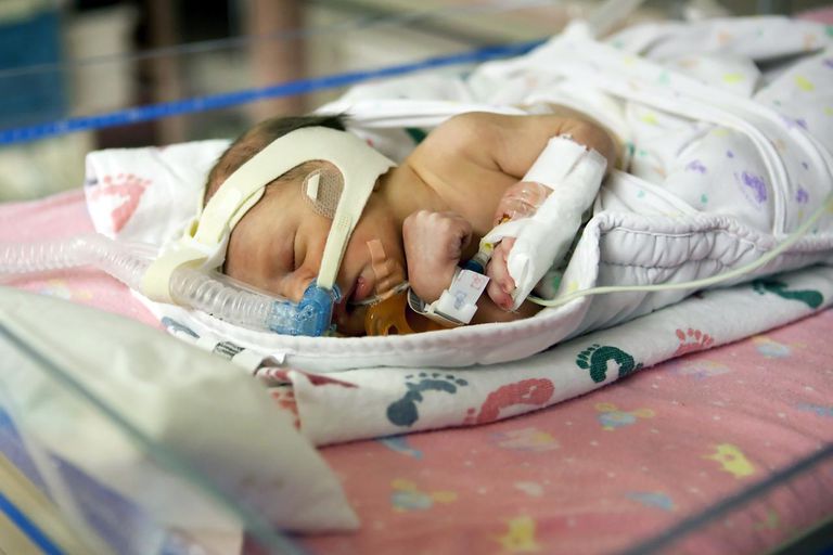 Bradicardia y apnea en bebés prematuros