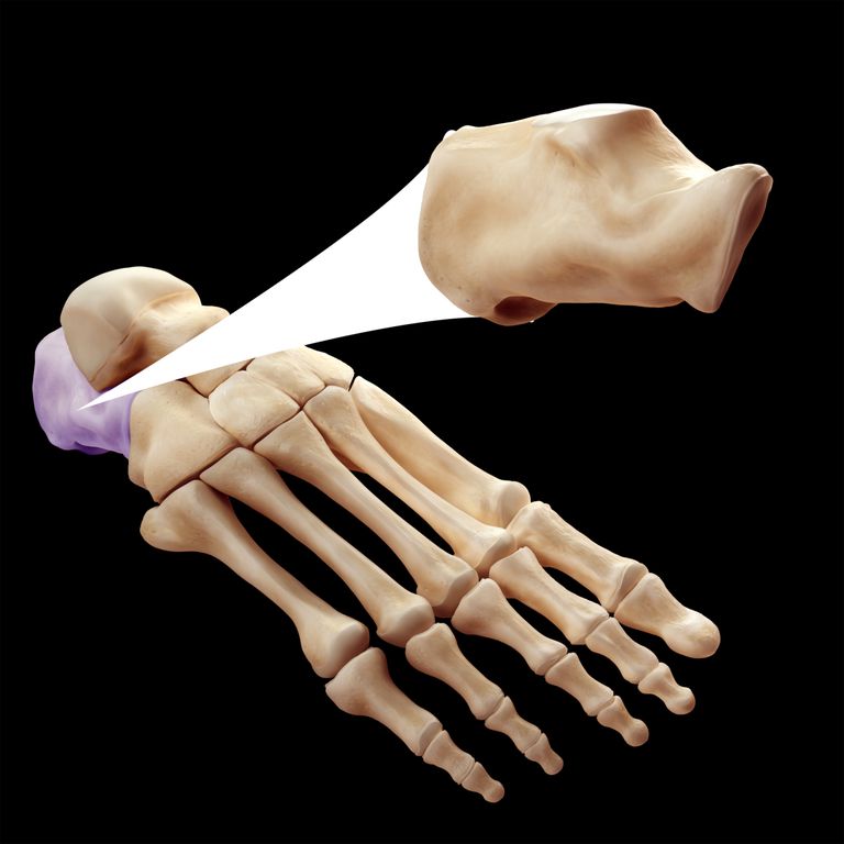 La fractura de calcáneo es un hueso del talón roto