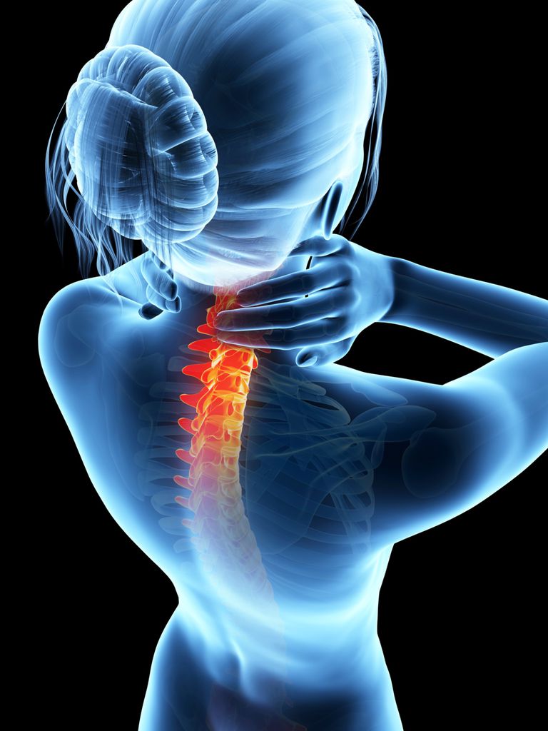 ¿Puede la artritis reumatoide afectar la columna vertebral?