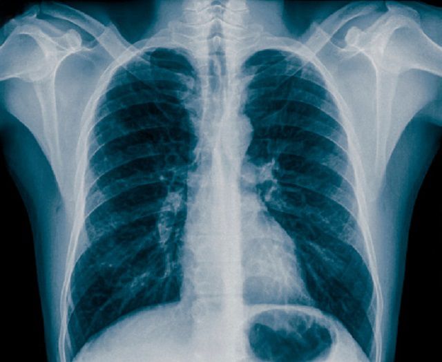 Papel del radiografía de tórax en la detección y el diagnóstico de asma