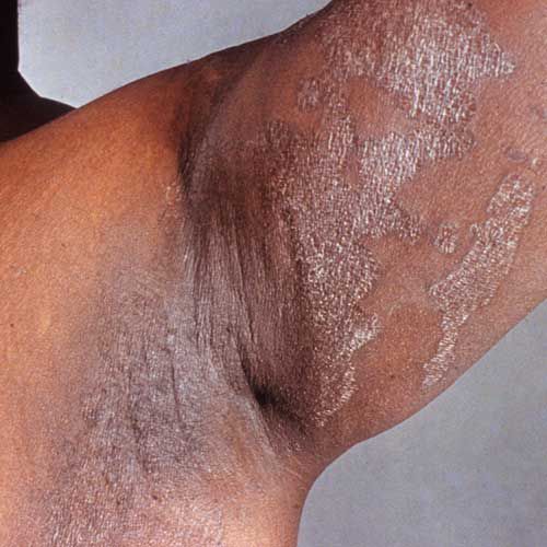 Infecciones bacterianas comunes de la piel